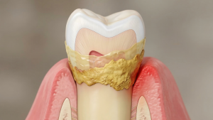 Foto de diente con Sarro Dental Natudental Montequinto